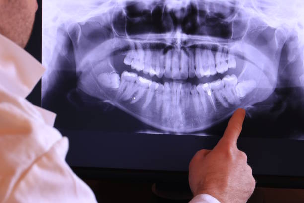 Best Emergency Wisdom Teeth Removal in Discovery Bay, CA