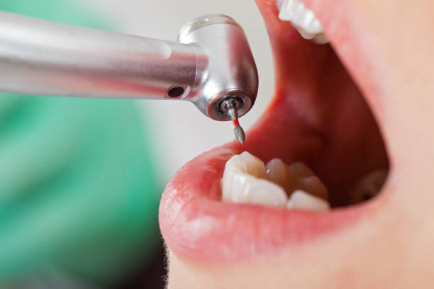 Best Urgent Care for Lost Fillings or Crowns in Discovery Bay, CA